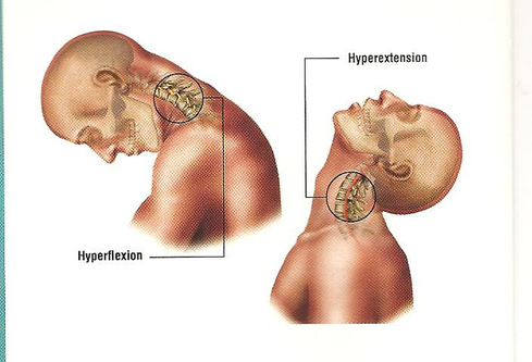 hyperextension neck