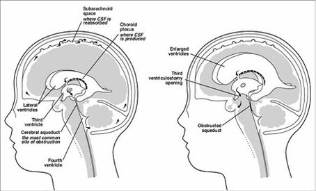 hydrocephalus obstructive ventriculostomy head health
